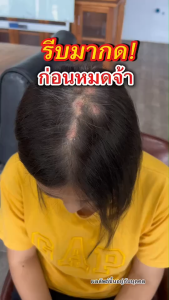 เเชมพูพญายอ 2แถม 2เพียง 580.-จบปัญหาหนังศรีษะ การหยุดร่วงของเส้นผม ขจัดรังแค ลดอาการคัน