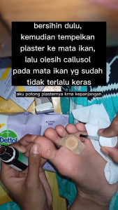 Ji Yan Gao Plester Mata Ikan Hansaplast Obat Penghilang Kutil Seluruh Tubuh Hilang Permanen