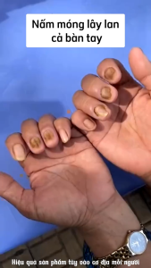 Tinh Chất Nấm Móng Dưỡng Móng Giảm Thối Móng Hết Vàng Móng Kannedo Nhật Bản 30g - Cải Thiện Cấu Trúc Móng Giảm Nứt Móng Kháng Khuẩn Chống Viêm Chống Nấm Giảm Ngứa Giảm Đau Kích Ứng Làm Mềm Móng Móng Mọc Nhanh Chắc Khỏe Bóng Đẹp | Moska