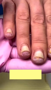 Tinh Chất Nấm Móng KANNEDO - Serum Nấm Móng Nhật Bản Kannedo Cải Thiện Hỏng Móng Phục Hồi Và Nuôi Dưỡng Móng