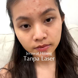 Masker Wajah Polynia Orange Brightening: Solusi untuk Bekas Jerawat & Kesehatan Kulit