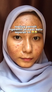 Paket Lengkap Perawatan Jerawat - Serum Acne & Luminous Glow | Skincare Viral BPOM & HALAL