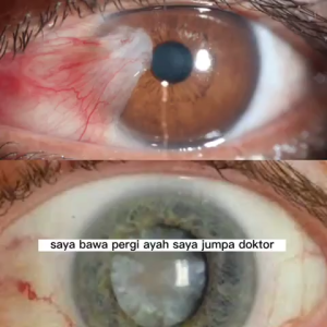 GLAZ EYE DROP PENAWAR MATA Katarak Rabun Pedih Gatal Resdung by RAYNIA SECRET