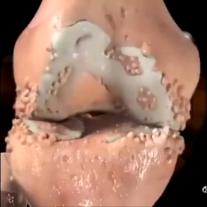 Mỡ Đau Khớp Đầu Gối Chuyên Nghiệp Nọc Ong Kem Bôi Bee Venom Giảm Bệnh Gout