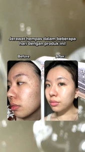 Hanasui Serum Anti Acne: Solusi Ampuh Mengobati Jerawat