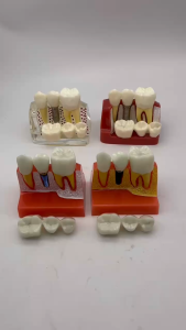 Teeth Model Dental Implant Model Dental Teaching Model Removable Tooth Model