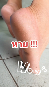 โปร 2 กระปุก 500 ครีมเท้าคุณนาย