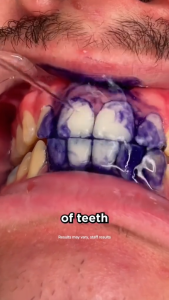 Eelhoe 2 Pcs Set V34 Colour Corrector Pemutih Gigi Kuning & NH Pro Enamel Serum Gigi Sensitif