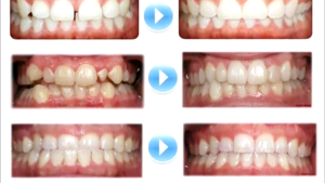 Aligner Gigi Trainer allignment Alat Perapi Gigi Lepas Pasang Meratakan Gigi Bertahap