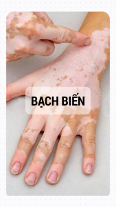 Xịt Bạch Biến Cổ Truyền Nhật Bản Loại Bỏ Da Bạch Biến Lang Ben Hắc Lào Viêm Da Cơ Địa Ngăn Chặn Lay Lan Cải Thiện Sắc Tố Da Ngứa Ngáy Tiêu Viêm Từ Sâu Lỗ Chân Lông Làn Da Khoẻ Mạnh Mềm Mịn Giúp Da Đều Màu An Toàn Lành Tính Senko 100ml | Moska