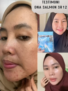 Paket Perawatan Kulit Wajah SR12 Serum Essence - Penghilang Flek & Jerawat dengan Ekstrak Salmon BPOM
