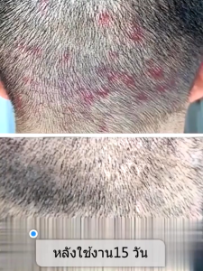 ยาสระผมขจัดรังแค ยาสระผมผมร่วง ยาสระผม 500ML 5Xกรดมะนาว ขจัดรังแค แก้คัน ลดผมร่วง ควบคุมความมัน