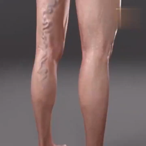 Varicose Veins Patch Helps Minimize Varicose Vein & Spider Vein | Reduce Swelling | FDA Approved | 1 Sachet - 12 Patches