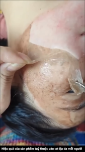 Mặt Nạ Lột Nám Dưỡng Xoá Nhăn TVLV - Dưỡng Lột Nám TVLV Làm Mờ Các Nếp Nhăn Ngăn Ngừa Lão Hoá Trẻ Hoá Da