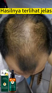 Serum Essensial Oil Obat Minyak Penumbuh Pelebat Pemanjang Penghitam Rambut Botak Cepat Anti Rontok