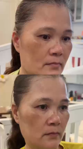 Combo TX cải thiện thâm nám dưỡng trắng da Serum 30ml + Kem 50g Dr Melaxin