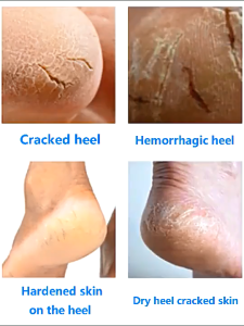 Krim Kaki Pecah Dan Kering Tumitku Obat Kaki Pecah Original Obat kaki pecah dan kering Foot Cream Penghalus tumit kaki