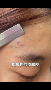 Acne removal oil control firming improvement dark spots cleansing face fades acne marks shrinks pores essence