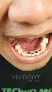 [ORI100%] VIVIDENT PLUS MOUTHWASH MENGHILANGKAN BAU MULUT PEMBASMI KARANG GIGI KUMAN & BAKTERI PAKET 3 BOTOL