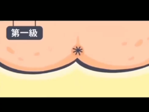 Original HERBAL Hemorrhoids Spray Natural Safe and Effective Treatment of Hemorrhoids Chinese Medicine Shrink Swollen Hemorrhoid Tissue Reduce Heat and Inflammation Relieve Hemorrhoid Pain Clear Away Toxic Materials Remove Decayed Tissues