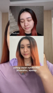 Paket Perawatan Jerawat - Kyura Acne Kit