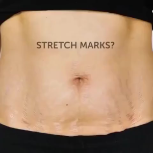 Stretch Mark Removal Scars Repair Acne Mark original obesity lines remover strech mark remove postpartum stretch marks and fat lines Repair body cream Skin Slackens Skin Repair Treatment Scars Repair Stretch mark cream