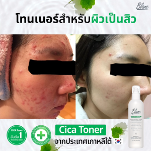 Blanc Nature โทนเนอร์ลบสิวและกระชับขุมขน *อันดับ 1*