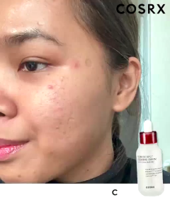 【100% persen sertifikasi resmi】COSRX AC Collection Blemish Spot Serum - 40ML (Serum untuk Noda Hitam)