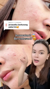 [5pcs] KYMM SKIN Anti Acne Package | Perawatan Facial Wajah Treatment Berjerawat Noda Hitam Pencerah Muka