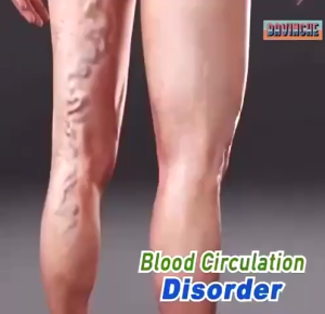 Varicose vein cream earthworm leg blood vessel expansion massage leg pain relief dredge meridian varicose vein care repair cream 50g