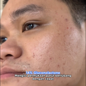 RAUMEN Acne Fading Serum Pitted Scars Dark Spots And Restores Skin For Men Original Supports Reduction 30ml
