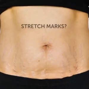 💫7 Days Eliminate Stretch Marks💫,Dr.Jungle Stretch Mark Remover CreamMaternity Whitening Body Lotion Tightening Body Care Reduce Scar Remover CreamBody Massage Lotion,30ml