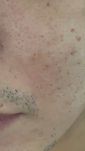 DERMASUCTION เครื่องดูดสิว สิว สูญญากาศ der ดูดสิว ผิว ผิวหน้า ฟรีหัวดูดสิว 4 หัว 1 กล่อง จำนวน 1 เครื่อง