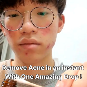 Official Instant Acne Remover Magic Teatree Oil 20ml/Acne anti-inflammatory/ Orgarnic Teatree Oil/Acne Pimple