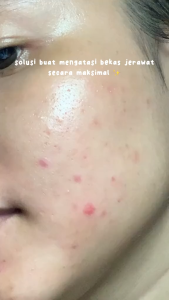 Reluvie Acne Serum | Serum mencegah & merawat kulit berjerawat dengan kandungan BHA - 10ml/20ml