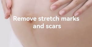 Feminine Remove Stretch Mark Oil - Essential Oil Blend for Smooth Nourished Skin