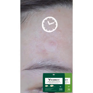 YOUBUY Spot Patch Acne Treatment Day/Night