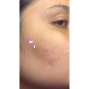 GLOW FX Glow Bomb Serum | Acne Pure Serum - Serum Glowing & Bekas Jerawat 19% Brightening Power