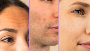 FOREO KIWI Derma Microdermabrasion Machine Whitehead & Black Head Remover for Face | Skin Care Tools | Blackhead Extractor | Vacuum Blackhead Remover Dermaforeo Microdermabrasion Crystals - Lazada