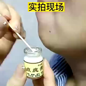 Wart removal APGAR Skin tags... Kem Chấm đốm nốt ruồi Cô đặc có tác dụng Nhanh chóng Không sẹo