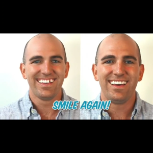 Instant Smile Temporary Tooth Kit 3 Warna Gigi Palsu x 10 Pcs + Bahan Pemasangan 1.5 Gr