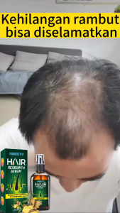 Serum Penumbuh Rambut & Hair Growth Spray: Solusi Rambut Botak & Rontok