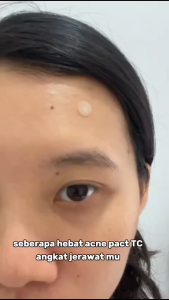 TEDDY CLUBS CLEAR 0.12MM MAKE-UP ACNE PATCH - WATERPROOF - SWEATPROOF