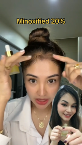 MINOXIFIED 20% hair growth 20% effective oily for your baby hair para walang airport SA noo