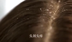 Shampoo kelemumur Anti dandruff shampoo syampoo kelemumur psoriasis shampoo 500ML itchy scalp shampoo 頭皮屑 洗發水