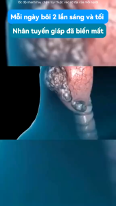 Kem Tan U Tuyến Giáp Senjoko Nhật Bản 50GR -Tan U Tuyến Giáp Cường Giáp Hiệu Quả