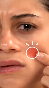 Sticker Jerawat Acne Cure Patch: Solusi Jerawat Tanpa Rasa Sakit