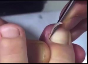 ชุดตัดเล็บขบ 4ชิ้น (ซองดำ) ชุดมีดตัดเล็บขบ และที่แซะ