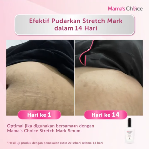 Mama Choice Skin Care: Perawatan Kulit Ibu Hamil & Mengatasi Stretch Mark