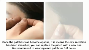 Acne Patch Jerawat Tempelan Jerawat Stiker Jerawat Acnes Pimple Patch Acnepenghilang Jerawat Dan Bruntusan Obat Jerawat Paling Ampuh Cewek 36pcs